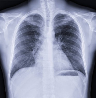 Chest x-ray image , Normal Chest.