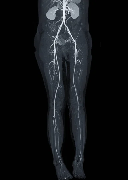 stock image CTA femoral artery run off showing  femoral artery for diagnostic  Acute or Chronic Peripheral Arterial Disease.