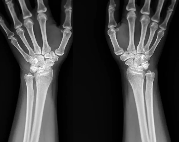 X-ray image of  wrist joint front view of normal wrist joint.