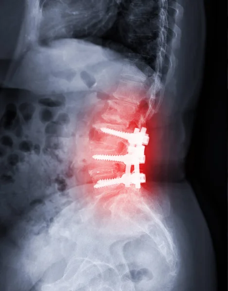 X-ray image of Lumbar spine showing pedicle screw fixation and decompression surgery in patient with spinal canal stenosis.