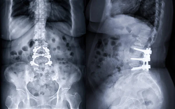 脊髄運河狭窄症患者における経皮的スクリュー固定および圧迫手術を示す腰椎のX線画像 — ストック写真