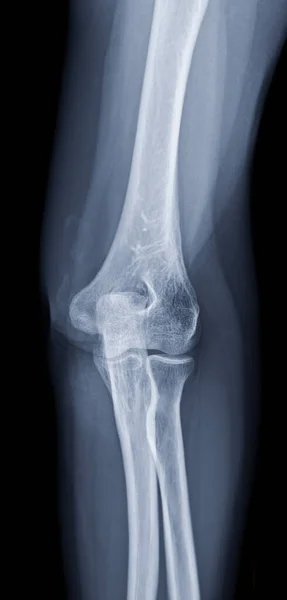 X-ray of Elbow join showing  Normal elbow joint.