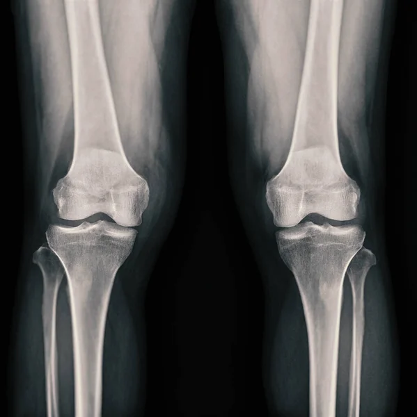Film x-ray  both knee joint  AP view showing normal knee joint.