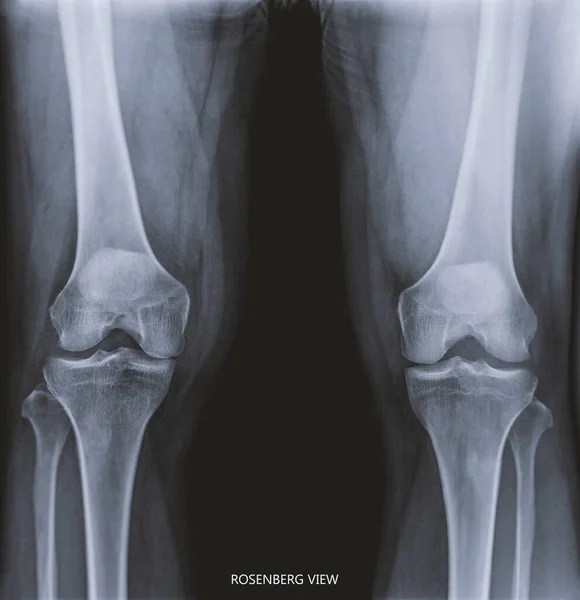 Film x-ray  both knee joint  AP view name is Rosenberg view  for diagnosis knee pain from osteoarthritis knee  and fracture .
