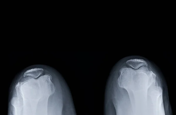 X-ray image of  both Normal patella .