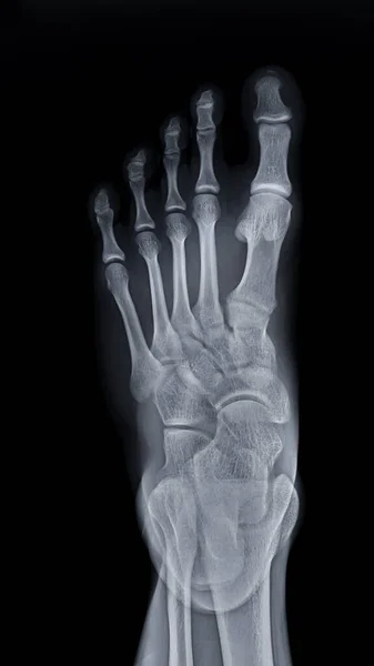 Foot x-ray image AP view  isolated on black background.