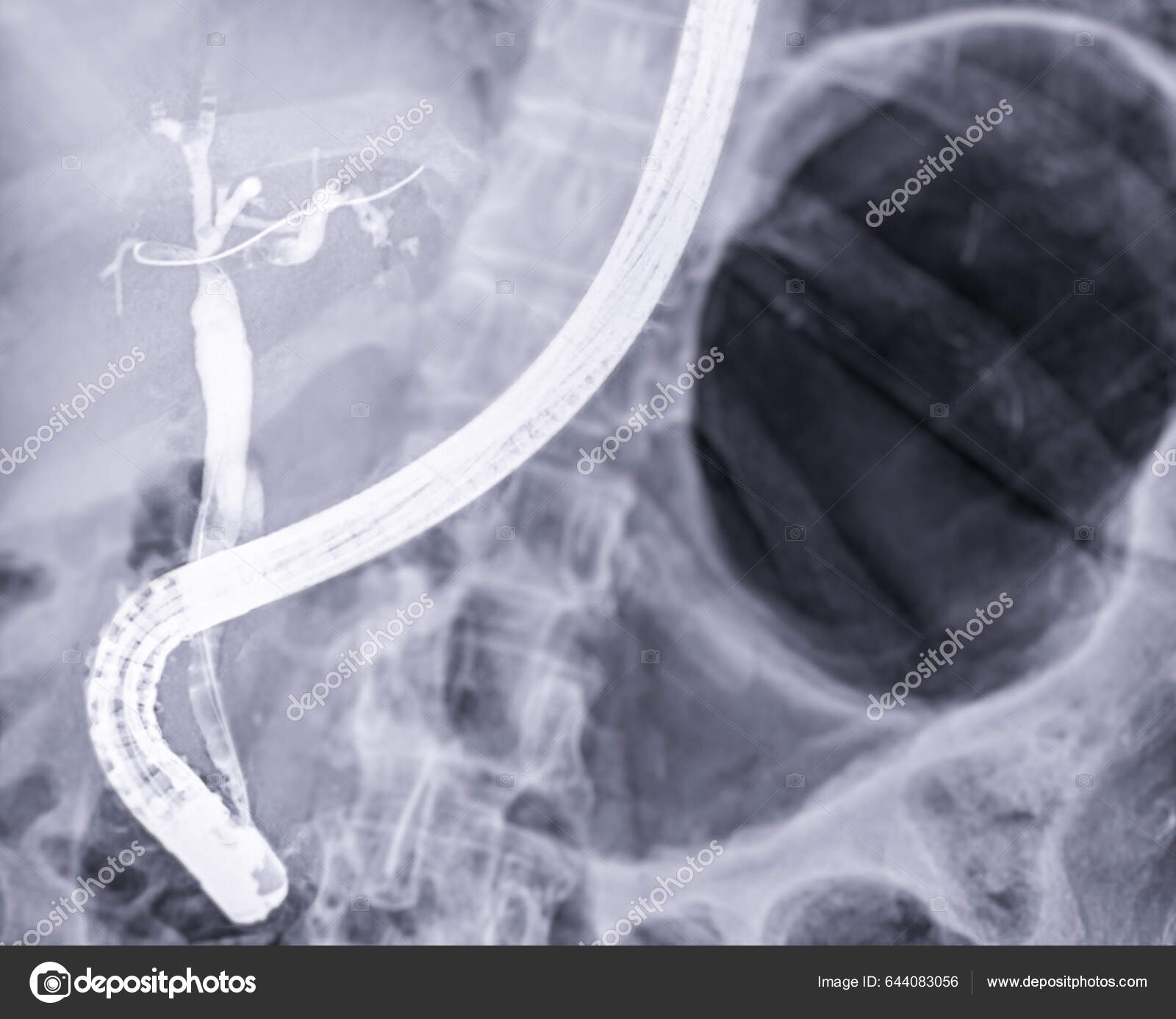 Ray Image Endoscopic Doctor Doing Ercp Laparoscopic Cholecystectomy
