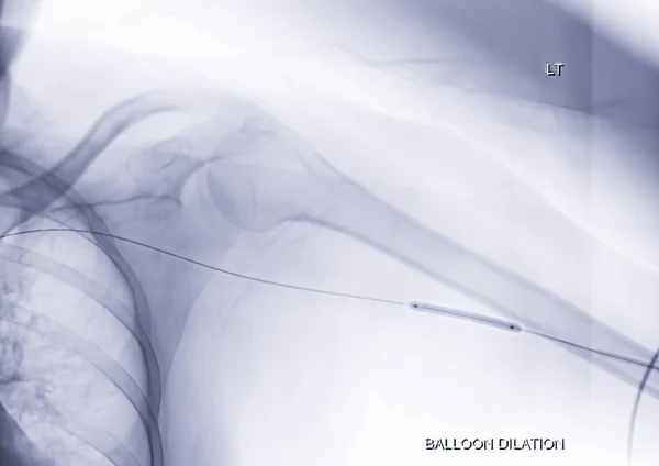 Angioplasty Balloon Angioplasty Percutaneous Transluminal Angioplasty Pta Left Arm — Stock Photo, Image