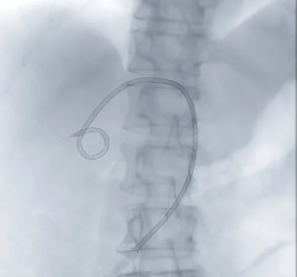 Imagem Radiológica Cateter Abdômen Superior — Fotografia de Stock