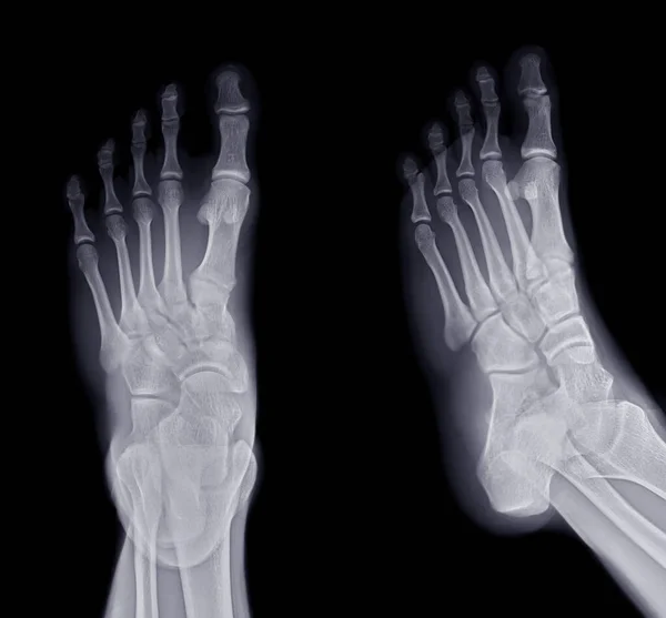 Fuß Röntgenbild Und Schrägansicht Isoliert Auf Schwarzem Hintergrund — Stockfoto