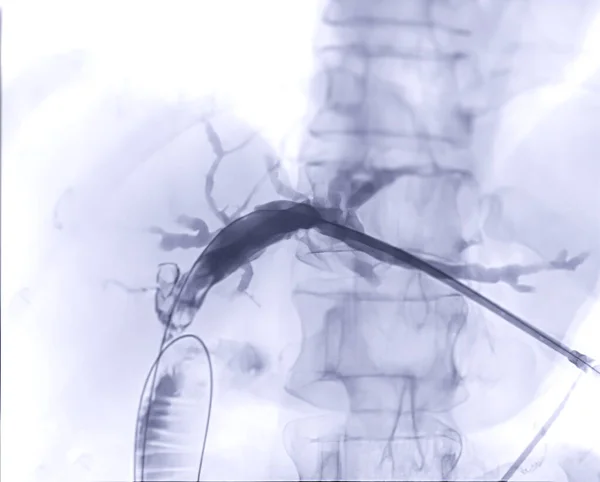 Modern Ameliyathanede Ercp Laparoskopik Kolesistektomi Yaptıktan Sonra Toplardamarın Röntgen Görüntüsü — Stok fotoğraf