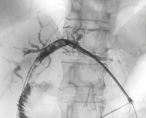 现代手术室实施Ercp和腹腔镜胆囊切除术后门静脉的X线图像 — 图库照片