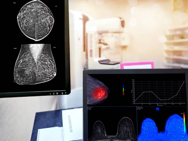 マンモグラフィーは マンモグラムの部屋の背景に乳房スクリーニング装置のためのモニターと機械 — ストック写真