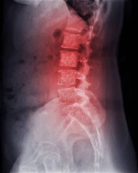 Imagem Radiológica Coluna Lambosacra Coluna Mostrando Metástase Óssea — Fotografia de Stock