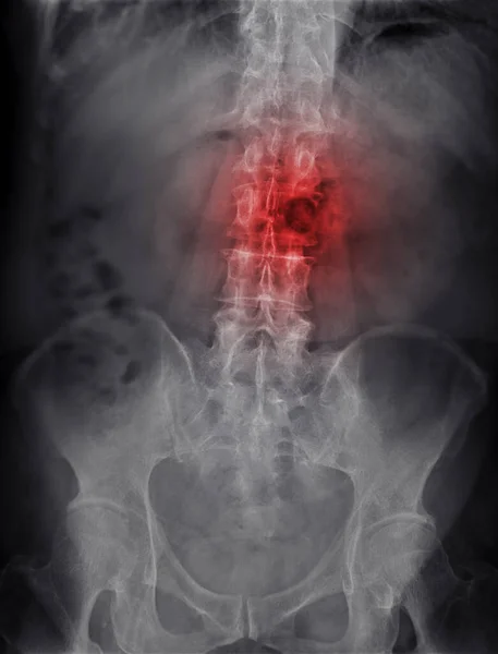 Imagem Radiológica Coluna Lambosacra Coluna Mostrando Lesão — Fotografia de Stock