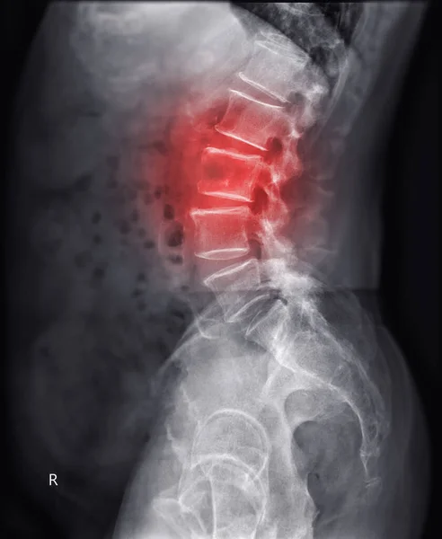 Imagem Radiológica Coluna Lambosacra Coluna Mostrando Lesão — Fotografia de Stock