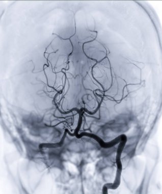 Flüoroskopiden kaynaklanan beyin anjiyografisi görüntüleyicisi veya seresterior serebral arter. Radyoloji baziler arteri gösteriyor..