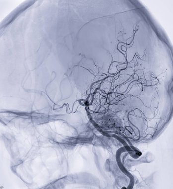 Beyin anjiyografisi görüntüleyicisi veya flüoroskopi sırasında oluşan seresterior serebral arter serebral arter..