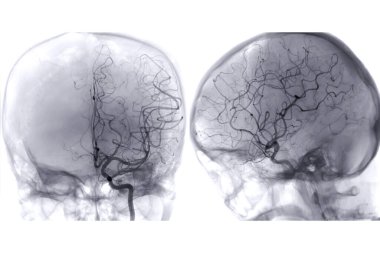 Cerebral angiography  image from Fluoroscopy in intervention radiology  showing cerebral artery.