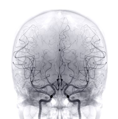 Cerebral angiography  image from Fluoroscopy in intervention radiology  showing cerebral artery.
