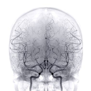 Cerebral angiography  image from Fluoroscopy in intervention radiology  showing cerebral artery. clipart