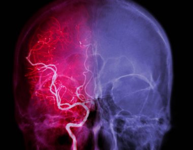 Cerebral angiography  image from Fluoroscopy in intervention radiology  showing cerebral artery.