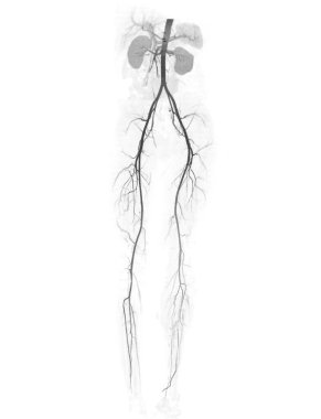 CTA uyluk atardamarı akut ya da kronik çevresel atardamar tanısı için uyluk atardamarı gösteriyor..