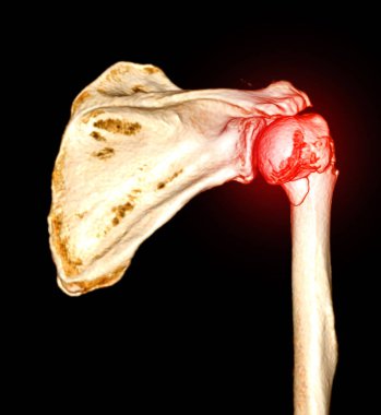 Tomografide sol omzun 3D görüntülemesi kol kemiğinin kırık olduğunu gösteriyor. .