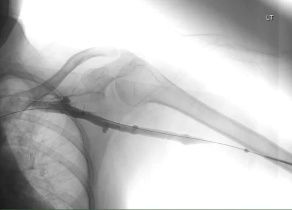 Afbeelding Van Angioplastiek Ballonangioplastiek Percutane Transluminale Angioplastiek Pta — Stockfoto