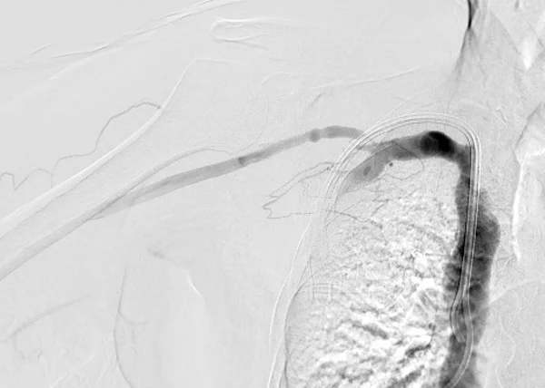 Зображення Ангіопластики Балонної Ангіопластики Переносної Транскумінальної Ангіопластики Pta — стокове фото