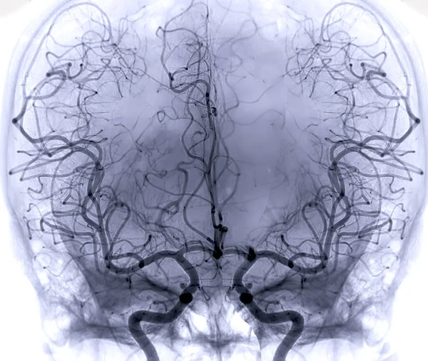 Cerebral Angiography Image Fluoroscopy Intervention Radiology Showing Cerebral Artery — стоковое фото