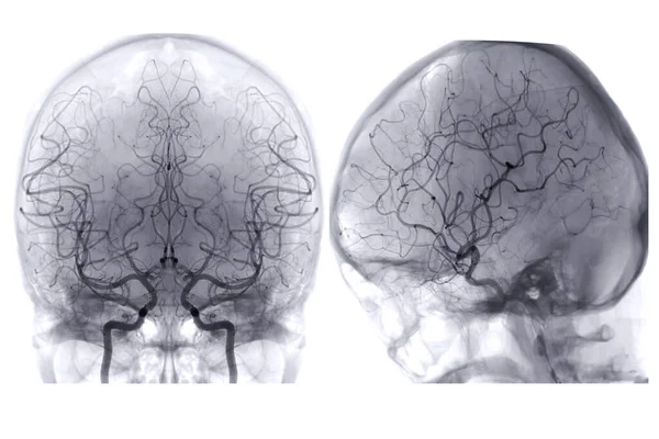 Cerebral Angiography Image Fluoroscopy Intervention Radiology Showing Cerebral Artery — Stockfoto