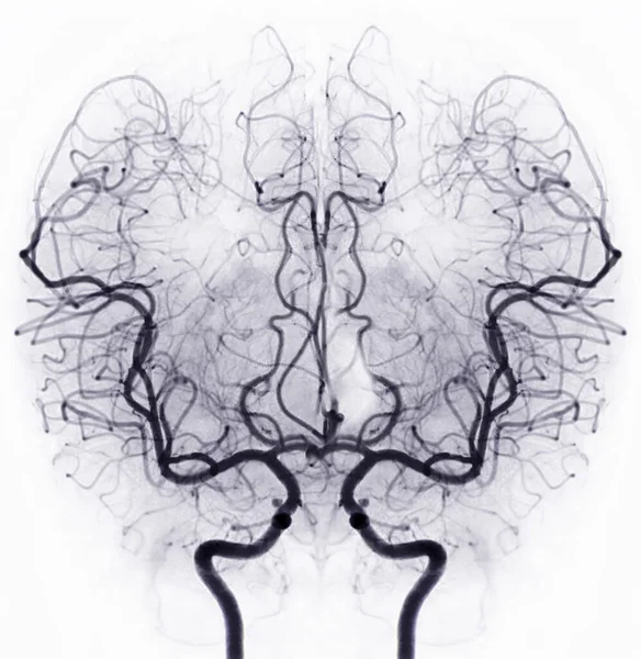 Cerebral Angiography Image Fluoroscopy Intervention Radiology Showing Cerebral Artery — Φωτογραφία Αρχείου