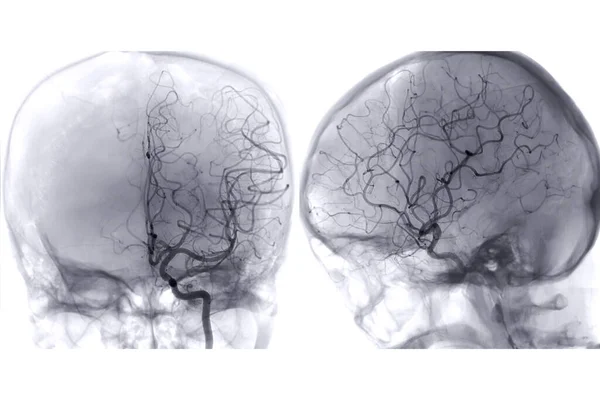 Cerebral Angiography Image Fluoroscopy Intervention Radiology Showing Cerebral Artery — Foto Stock