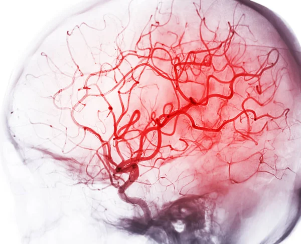 Cerebral Angiography Image Fluoroscopy Intervention Radiology Showing Cerebral Artery — Stock fotografie