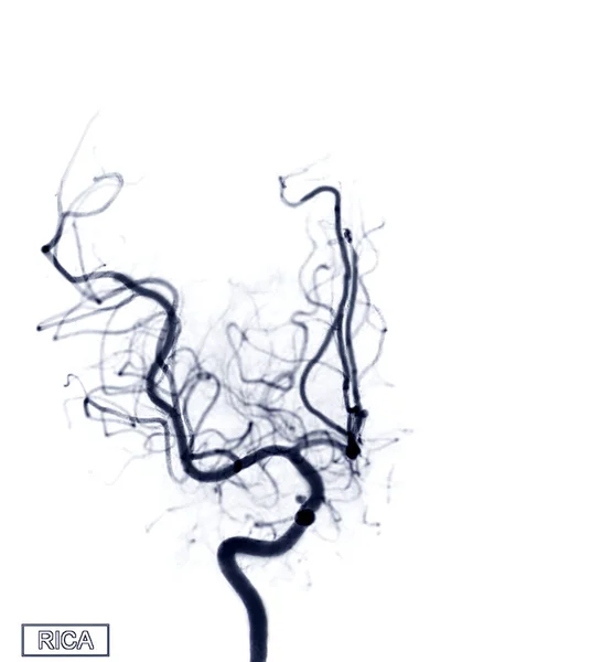 Image Angiographie Cérébrale Rica Par Fluoroscopie Radiologie Intervention Montrant Artère — Photo