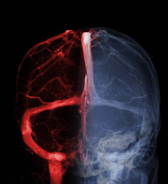 Venograpia Cerebrale Diagnosi Trombosi Venosa Cerebrale — Foto Stock