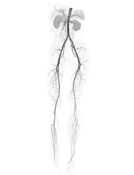 Cta Arteria Femoral Que Muestra Arteria Femoral Para Diagnóstico Enfermedad —  Fotos de Stock