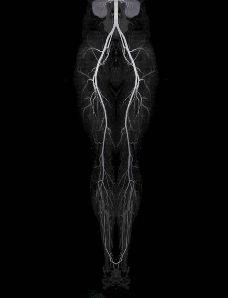 Cta股动脉走行显示股动脉诊断急性或慢性外周血管疾病 — 图库照片