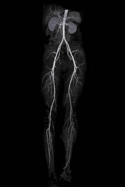 Cta Arteria Femoral Que Muestra Arteria Femoral Para Diagnóstico Enfermedad — Foto de Stock