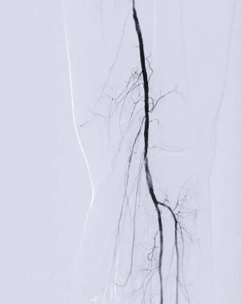 stock image Femoral artery angiogram or angiography 