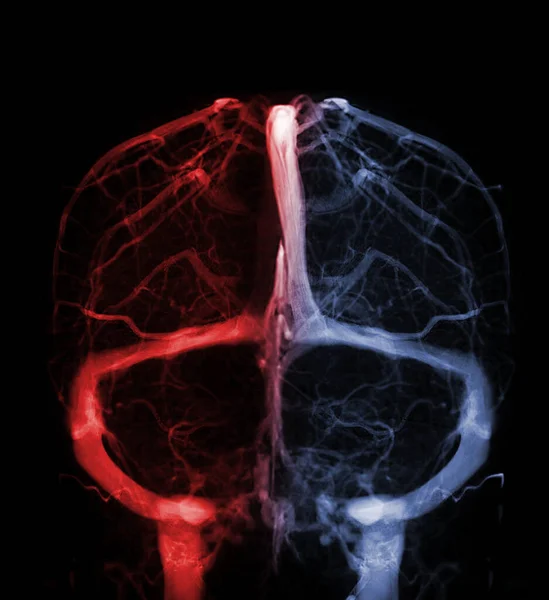 Venografías Cerebrales Para Diagnóstico Trombosis Venosa Cerebral —  Fotos de Stock