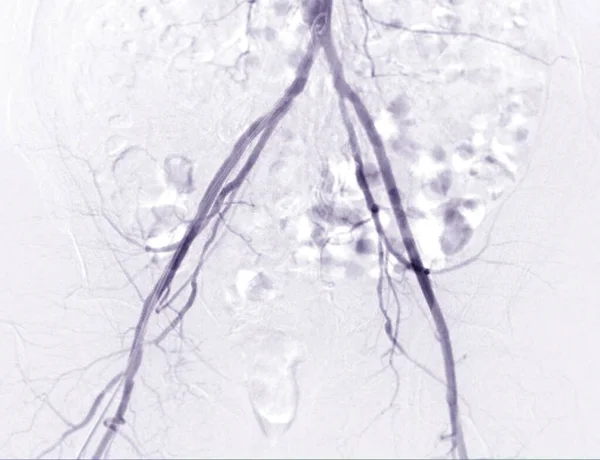 Dijbeenslagader Angiogram Angiografie — Stockfoto