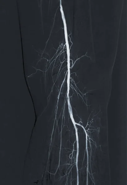 Artéria Femoralis Angiogram Vagy Angiográfia — Stock Fotó