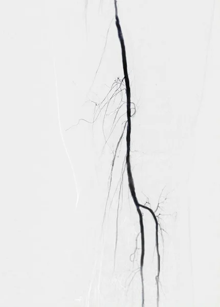 Angiogram Tętnicy Udowej Lub Angiografia — Zdjęcie stockowe