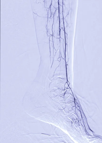 下肢股动脉造影或血管造影检查 — 图库照片