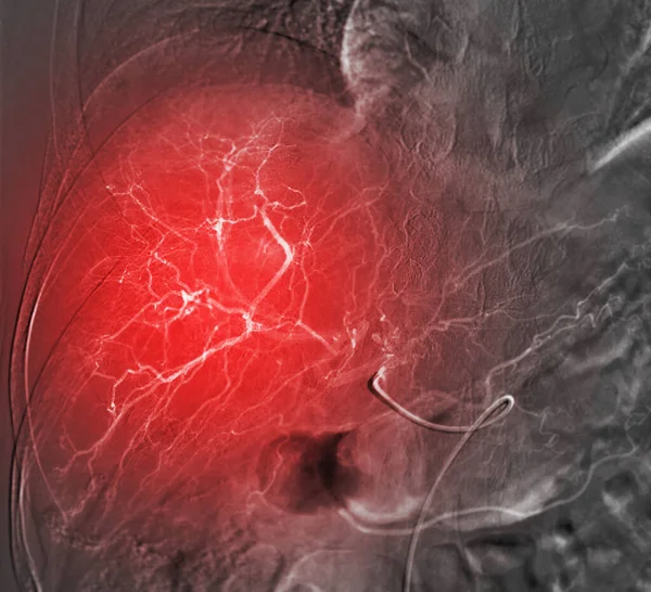 Tace Veya Kemoterapi Ilaçlarının Görüntülenmesi Karaciğer Tümörü Veya Hepatik Arter — Stok fotoğraf