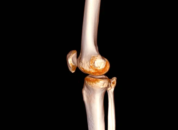 Escaneo Articulación Rodilla Representación —  Fotos de Stock