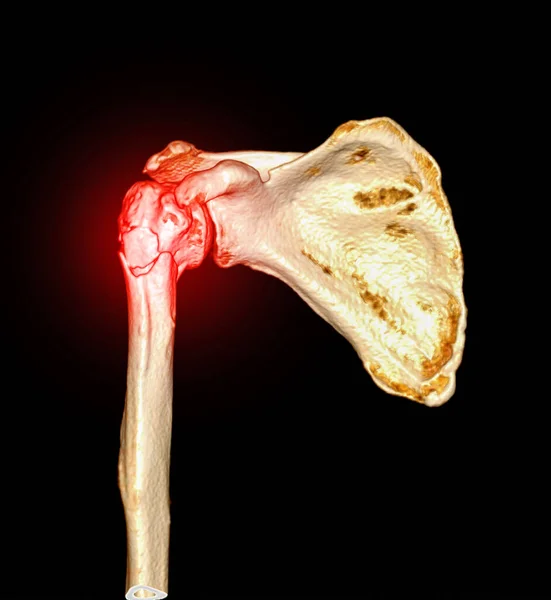 肱骨骨折左肩部Ct扫描三维成像 — 图库照片