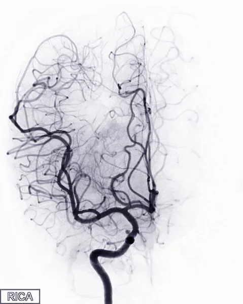Cerebral Angiography Image Fluoroscopy Intervention Radiology Showing Cerebral Artery —  Fotos de Stock